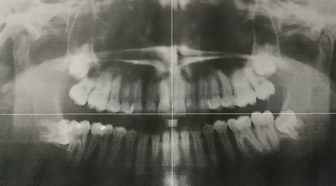 顎関節嚙み合わせ